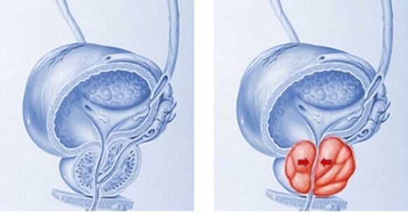 gesunde und entzündete Prostata mit Prostatitis